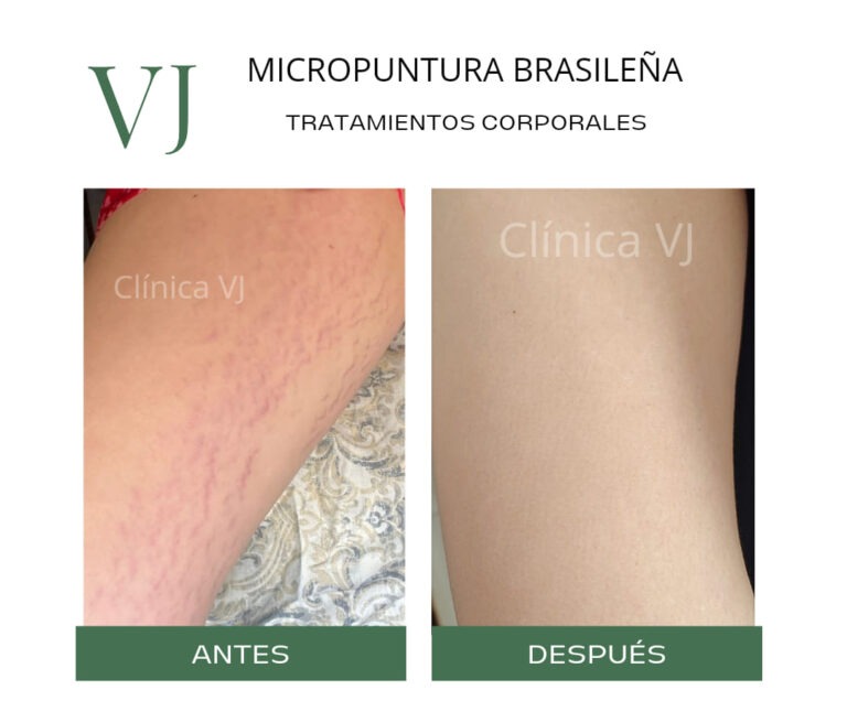 Micropuntura brasileña en puebla MX