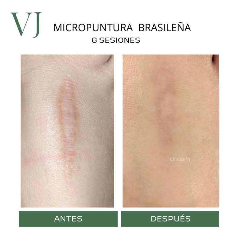 Micropuntura brasileña en puebla MX