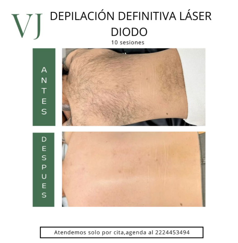 Depilación láser en puebla México