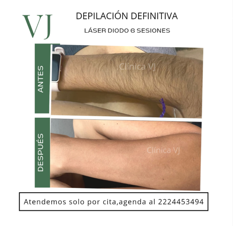 Depilación láser en puebla México