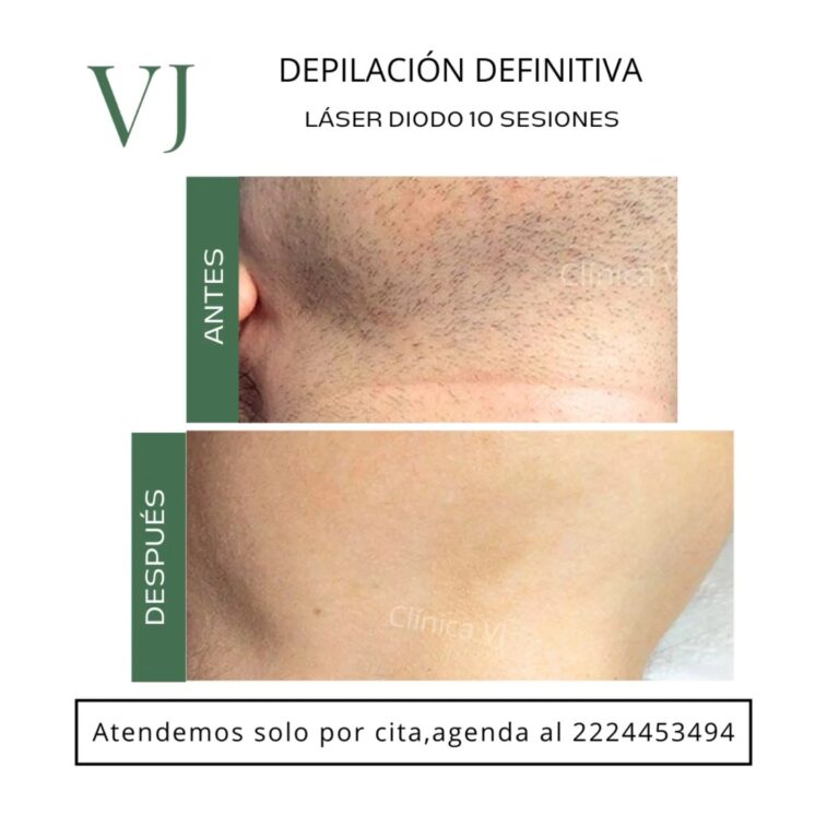 Depilación láser en puebla México