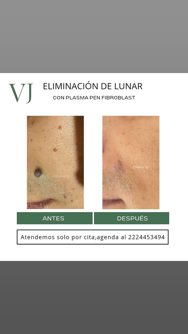 Eliminacion de verrugas y lunares en Puebla