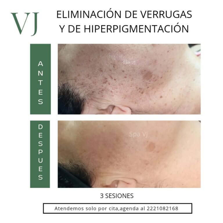 Eliminacion de verrugas y lunares en Puebla