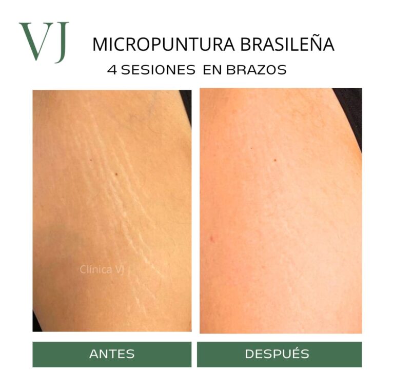Micropuntura brasileña en puebla MX