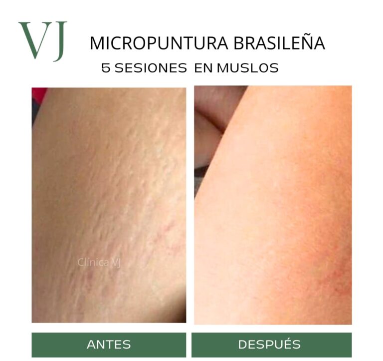 Micropuntura brasileña en puebla MX
